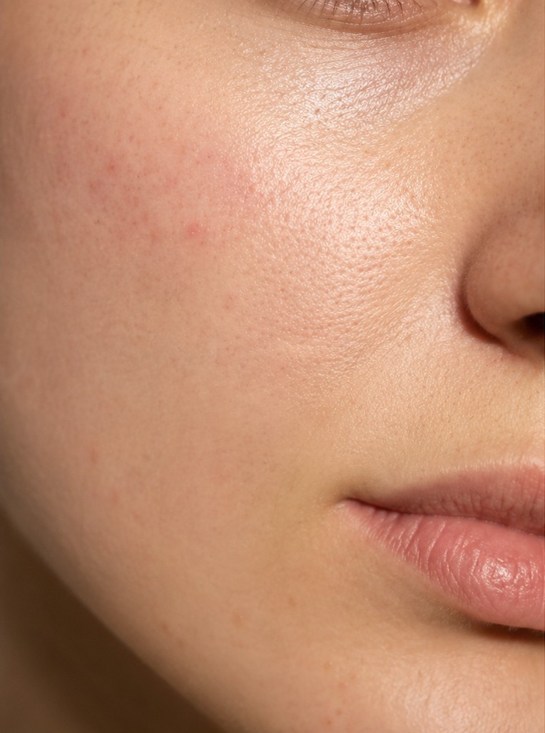 Peau avant le suivi avec Skin Progress